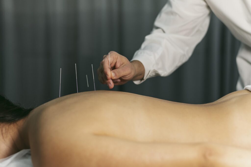 From Pain To Relief: The Power Of Acupuncture For Back Pain In Houston - Mirror Eternally