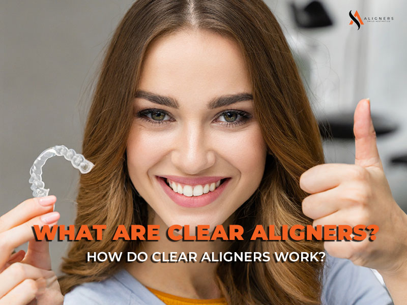 What are Clear Aligners? and How do Clear Aligners work?