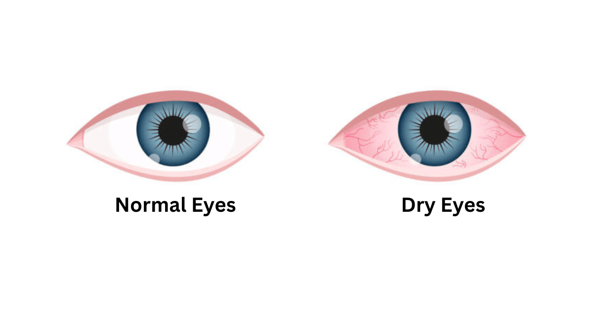 Dry Eyes: Factors, Treatment, and Preventing | Deevine Eye Care