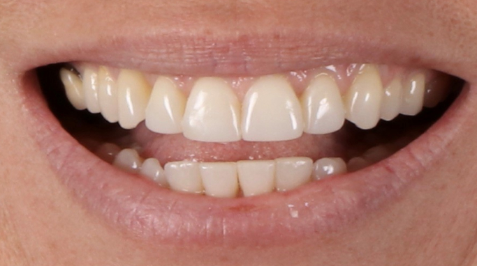 Invisalign - Dental Clinic - Enamel