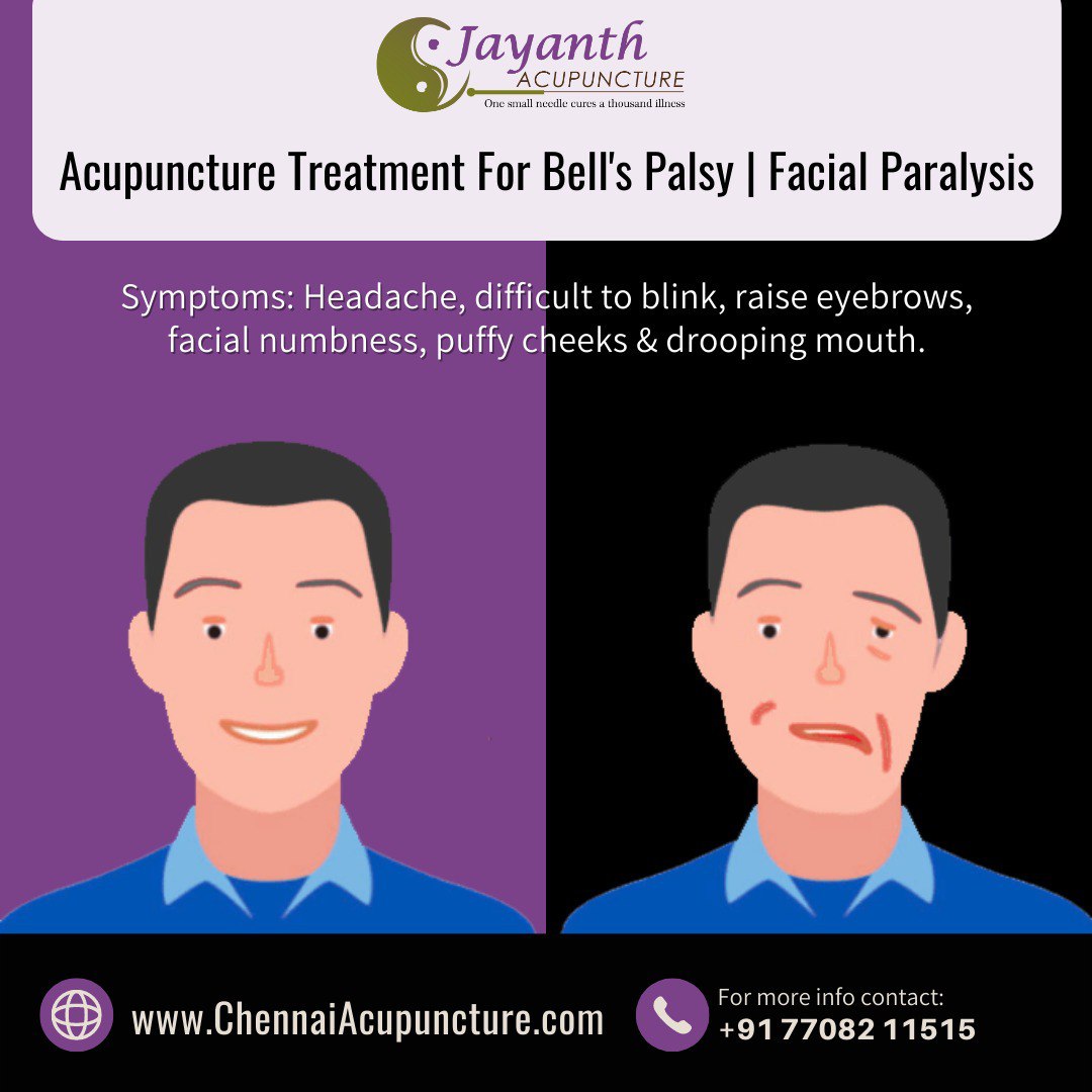 Acupuncture Treatment For Bell's Palsy | Facial Paralysis - Chennai