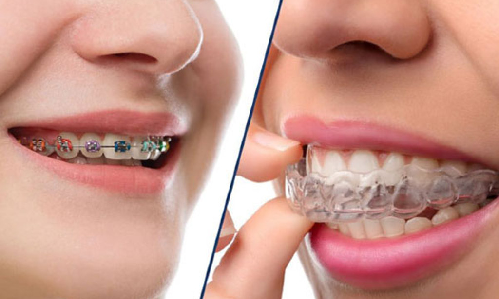 How Can Orthodontic Treatment Transform Your Smile?