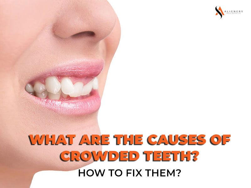 What are the Causes of Crowded Teeth and How to fix them?