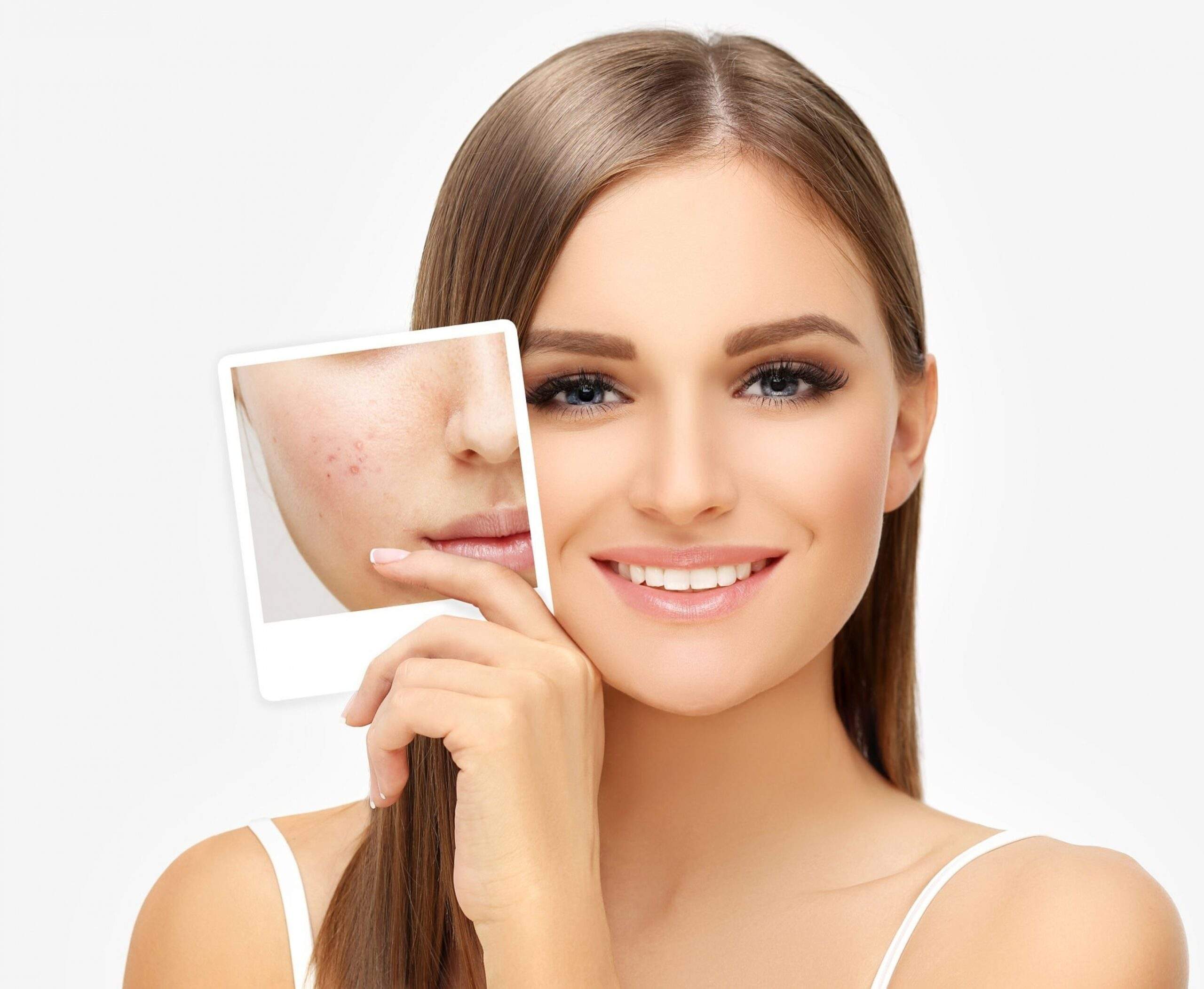 Acne Treatment in Bangalore | Dermatologist for Acne Scars