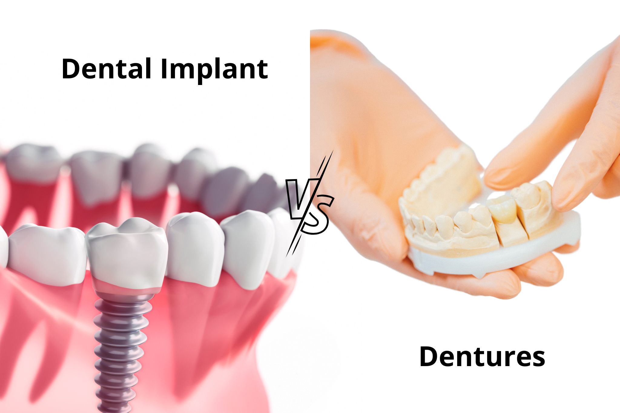 Dental Implants vs. Dentures: Which is Right for You? | TheAmberPost