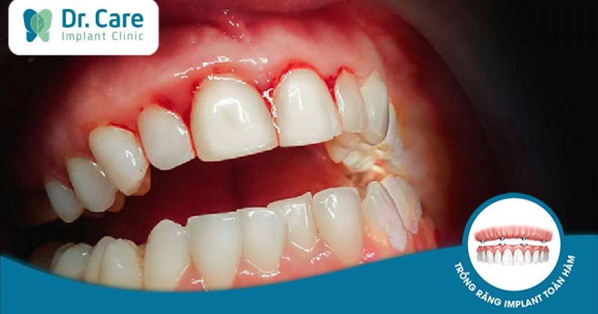 Nguyên nhân gây nên tình trạng chảy máu chân răng và cách điều trị | Dr. Care