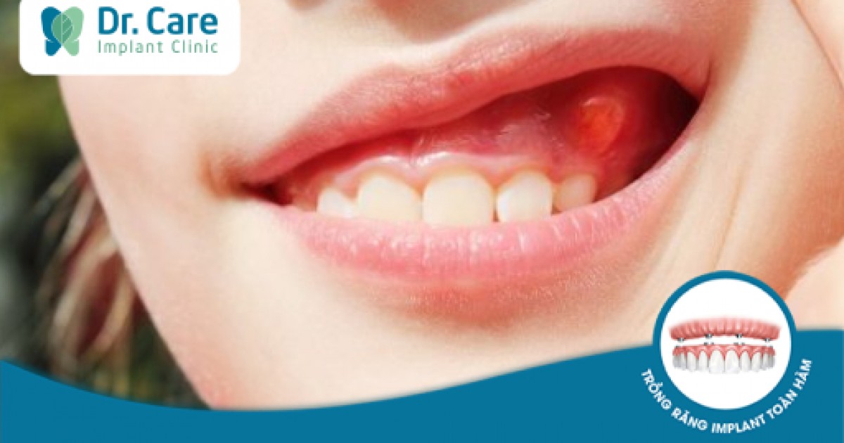 Áp xe răng - Dấu hiệu, nguyên nhân và nguyên tắc điều trị | Dr. Care