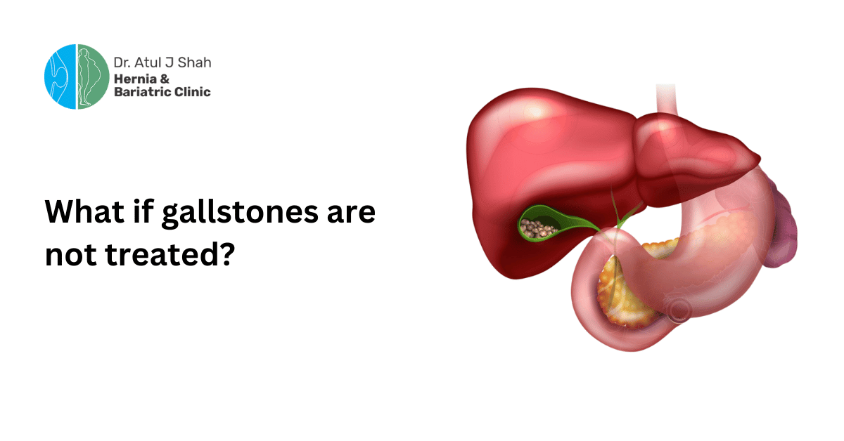 What if gallstones are not treated? | Dr. Atul Shah