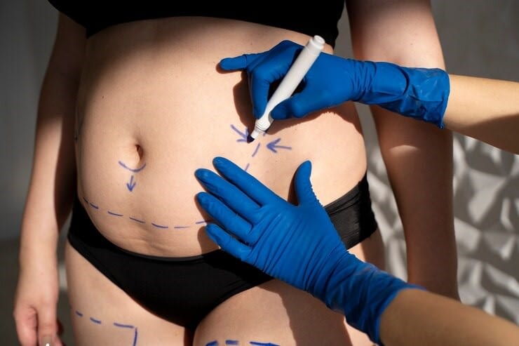 How Cellulite Body FX is a Sculpting Success? - Skincare Laser Center