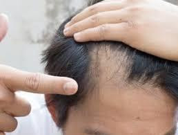 5 Reasons for Hair Loss in Men - JustPaste.it