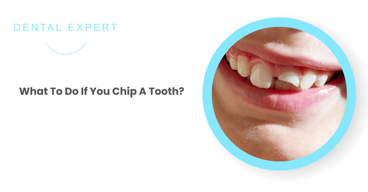 Expert Advice on Fixing a Chipped Tooth | Dental Expert Clinic