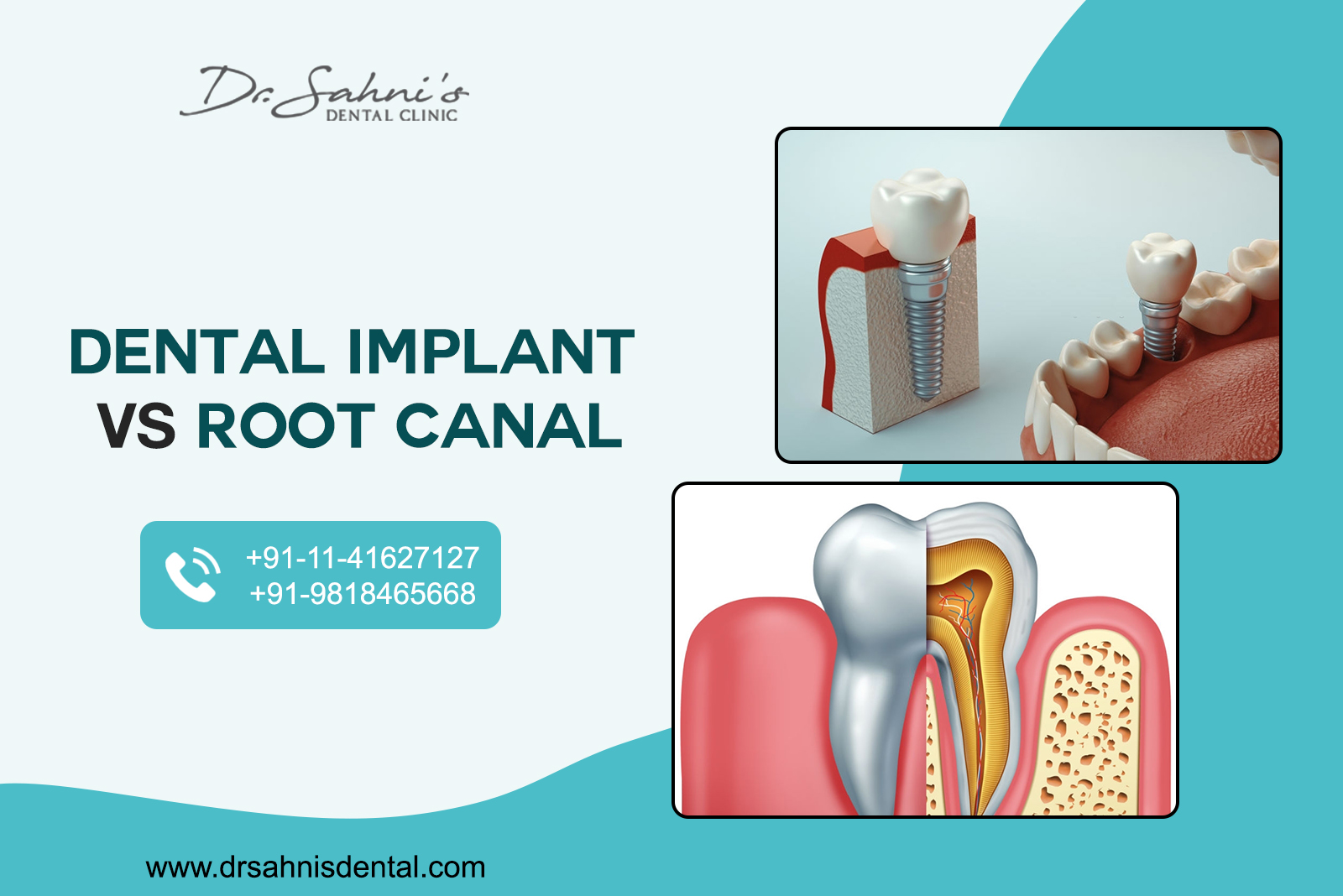 Dental Implant or Root Canal: Which Is Better? Dr. Sahni's Dental Clinic