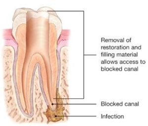 Breaking Down The Cost Factors Associated With Endodontic Treatments | TheAmberPost