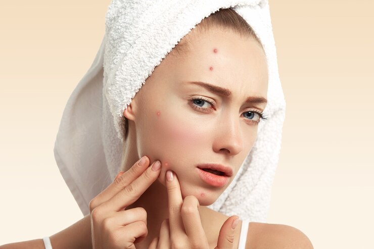 Differin Gel: What to Know About This OTC Acne Treatment? - WriteUpCafe.com