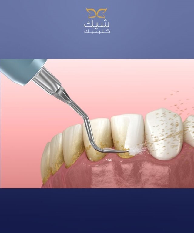 Teeth Whitening Dentist in Kuwait | Best Clinic & Treatment