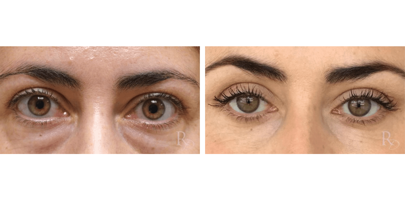 Before & After - Eyelid Revision Surgery - Raymond Douglas