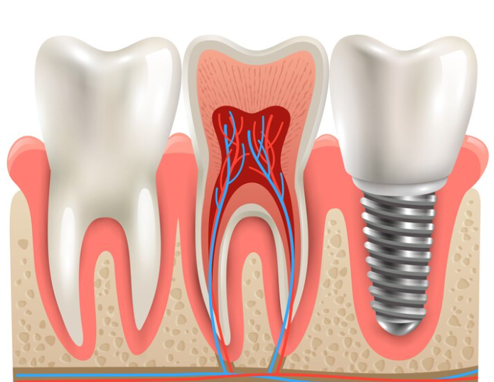 10 inquiries to Ask Before Getting Dental Implants | by Perfect 32 Dental Clinic And Implant Centre | Mar, 2024 | Medium