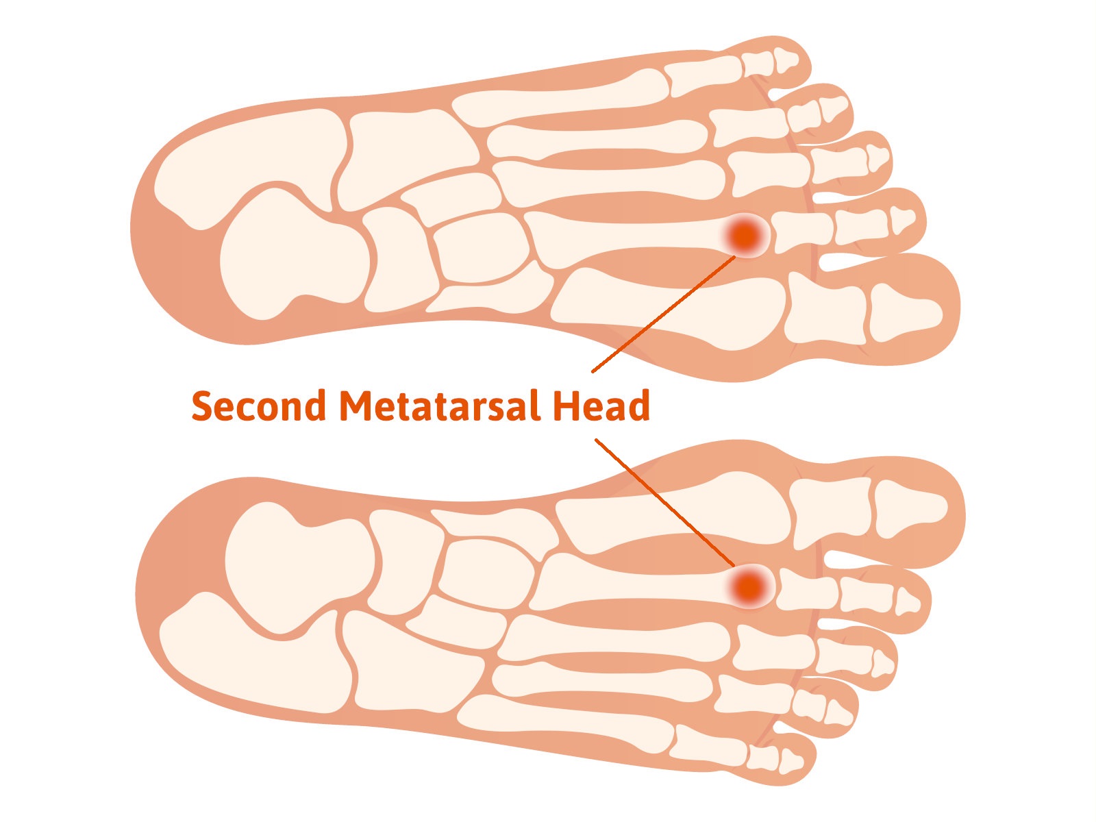 Freiberg’s disease is an often overlooked foot issue!