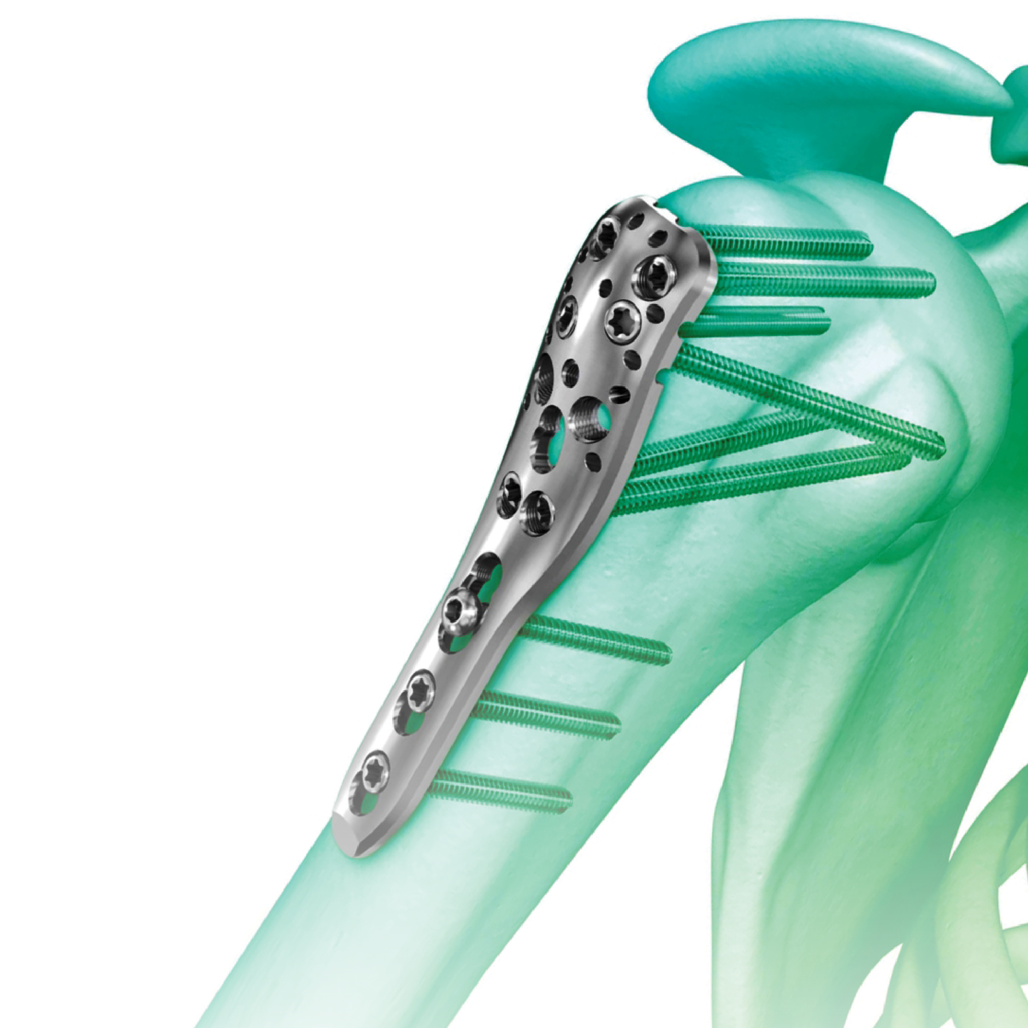 Best Orthopedic Implants Manufacturer, Supplier and Exporter Across the Globe - Zealmax Innovations Pvt Ltd