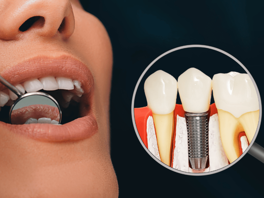 Can Implant Dentures Prevent Bone Loss and Preserve Facial Structure? | TheAmberPost