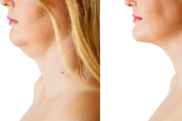 How the Neck Lift Can Change Your Overall Appearance - Shaper of Light