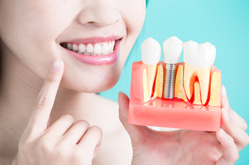 What Are Melbourne Dental Implants and How Do They Operate? – Creating Beautiful Natural Smiles For Life