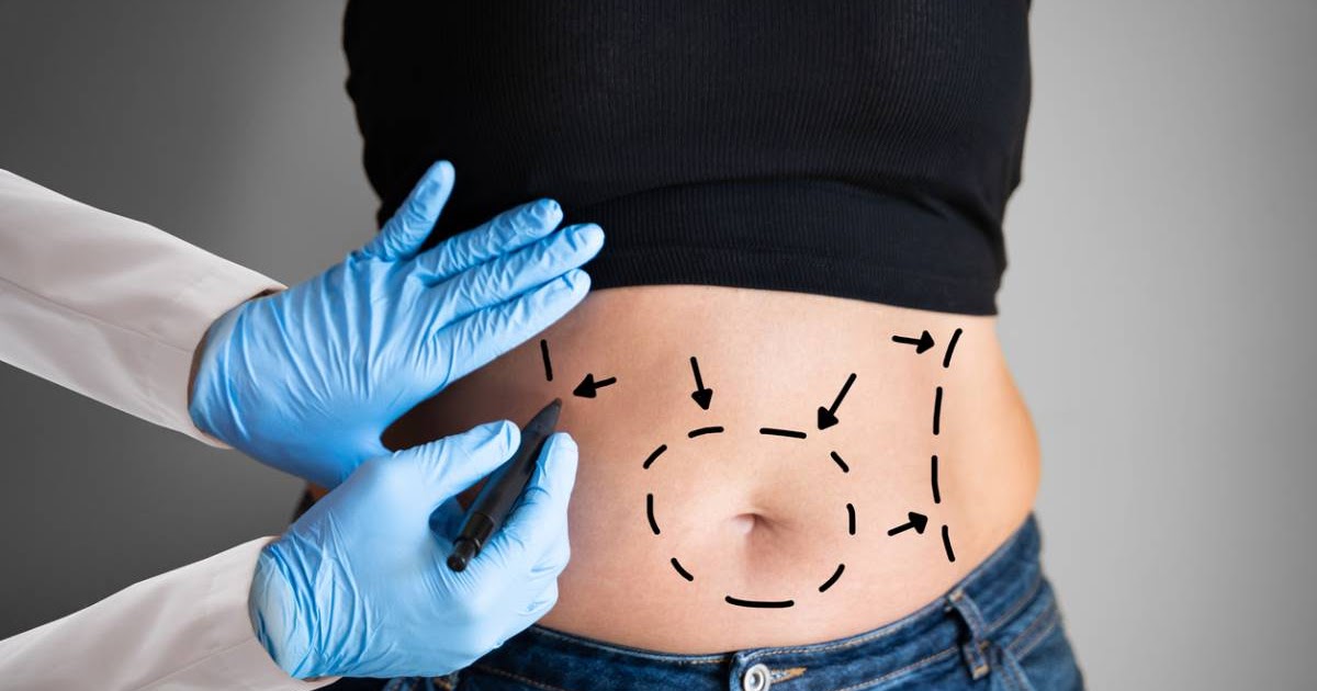 How to Choose the Right Advanced Tummy Tuck Recovery Techniques