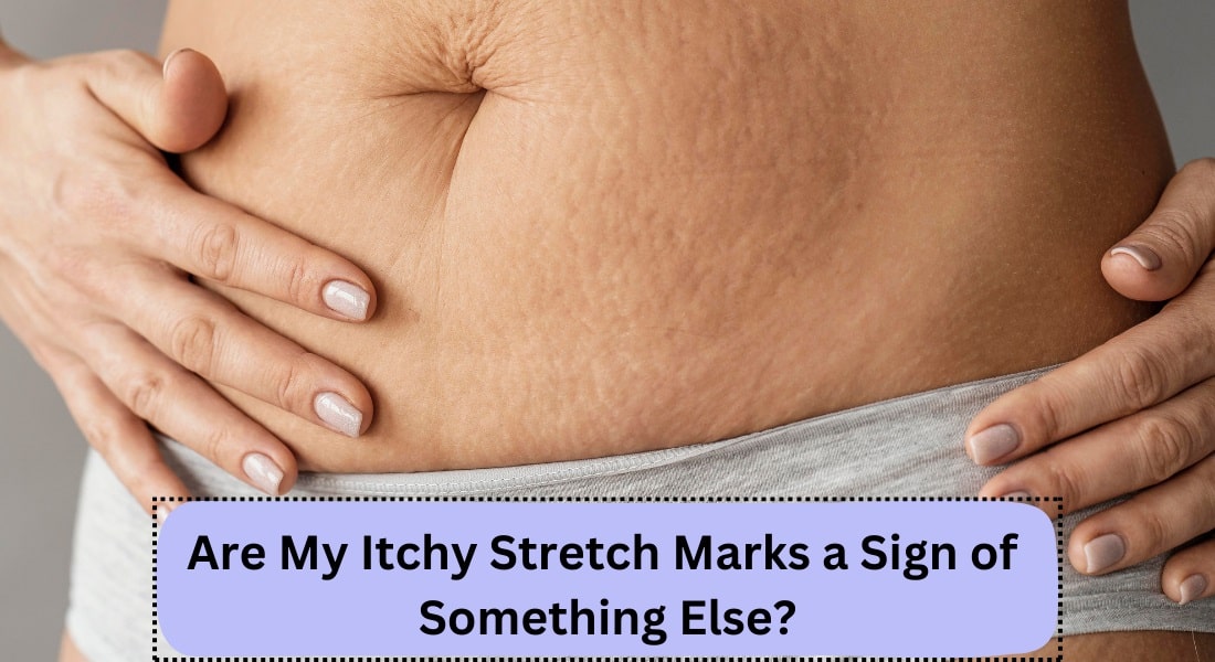 Are My Itchy Stretch Marks a Sign of Something Else? | WONGCW...