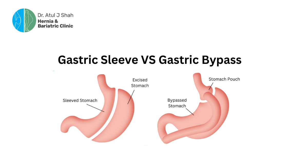 Gastric Bypass vs Gastric Sleeve | Guide by Dr. Atul Shah