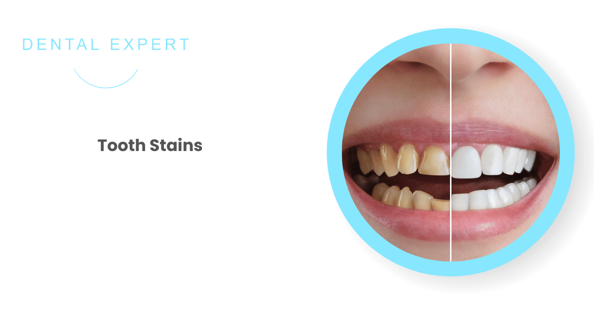 Tooth Stains: Everything You Need to Know About Them | Dental Expert