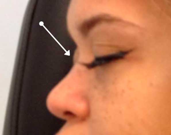 Best Non Surgical Nose Job Manhattan | Anand Medical Spa