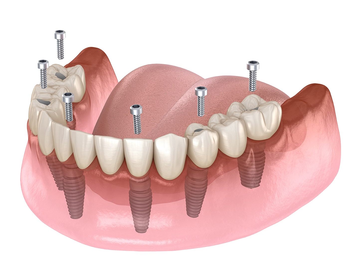 A Patient’s Guide to All-On-4 Dental Implant Procedure – Telegraph