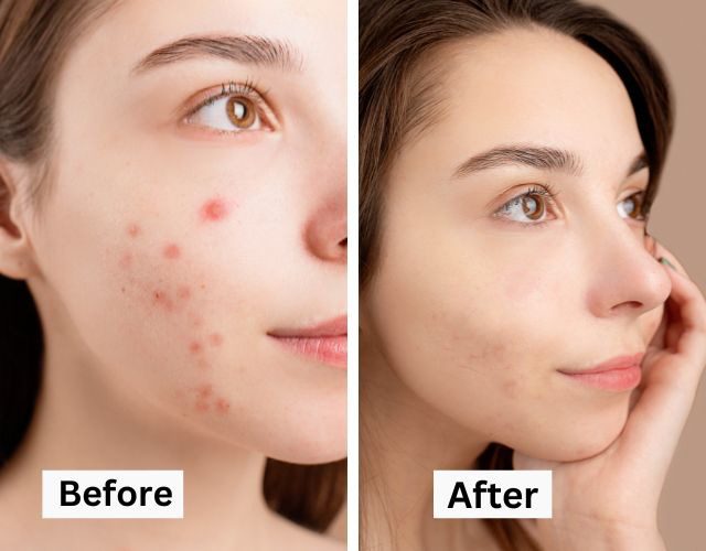 Do You Need To Use Tretinoin In Your Skincare Routine?