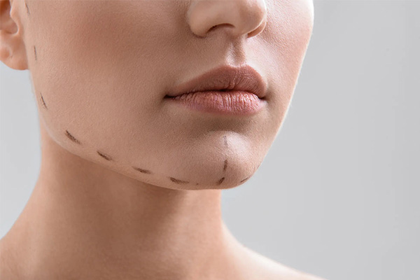How the Chin Implant Can Create an Impact on Your Life