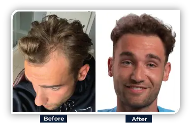 Modern Hair Restoration Technique to Regaining Confidence