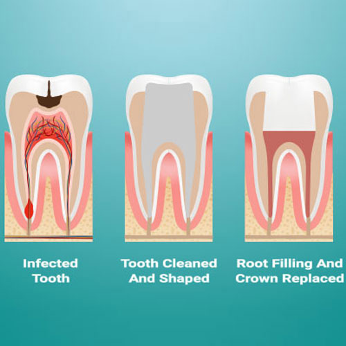 Laser Root Canal Treatment  in South Delhi | Best Dental Clinic, Best Dentist in South Delhi