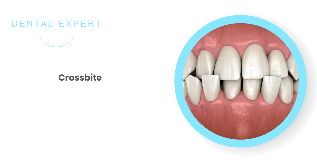 What is a crossbite? | Dental Expert