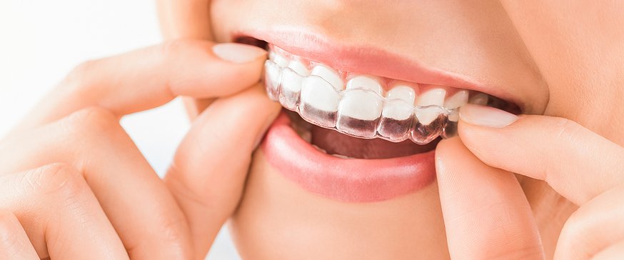 Important Information to Know Before Getting Invisalign | Pair Orthodontics