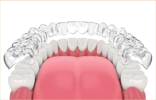 Few Rewards of Investing in Invisalign Braces for Oral Health – rochesterfamilyorthodontics