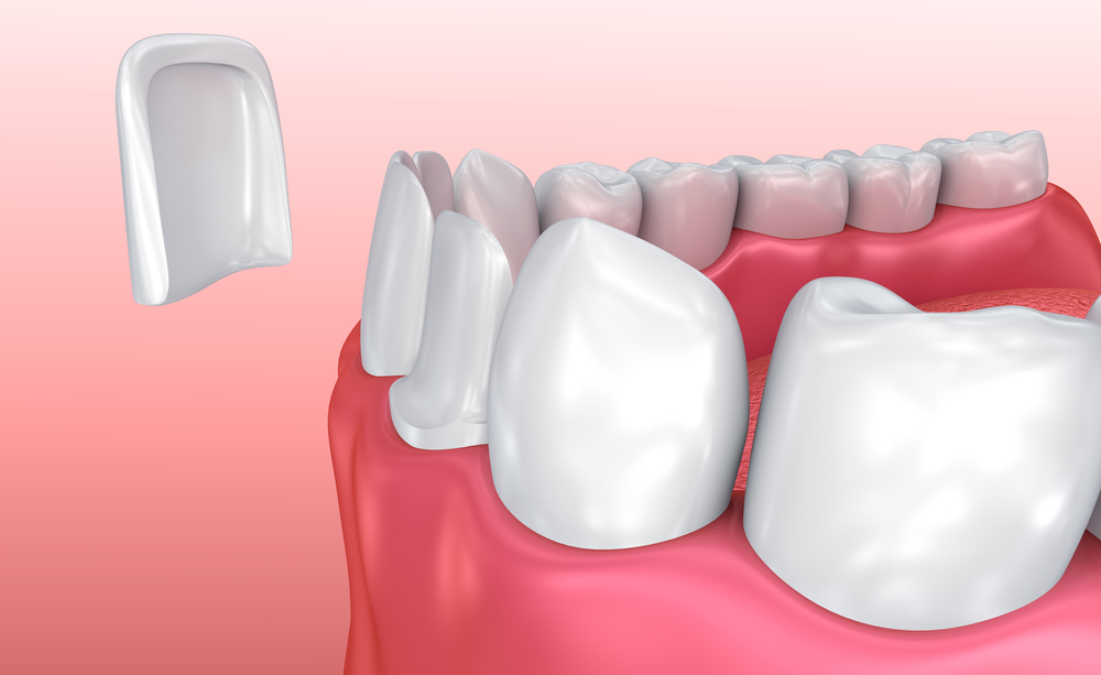 Factors to Consider for Dental Veneers - WriteUpCafe.com