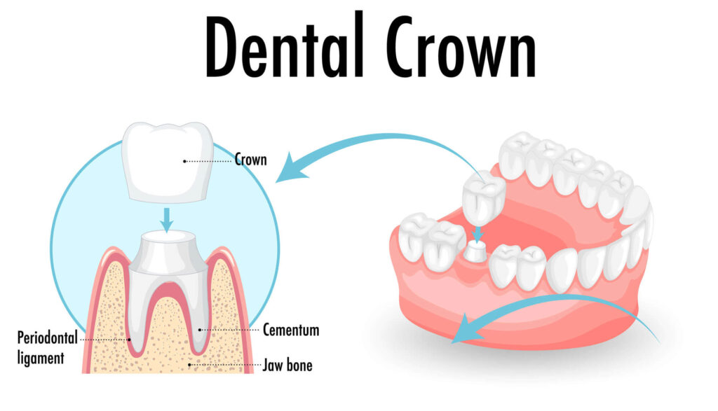 Understanding Tooth Crown Surgery: Procedure, Recovery, and Benefits