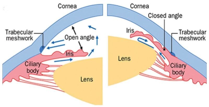 Glaucoma Surgery in Staten Island | Glaucoma Treatment | Dr. Luna Xu — Insight Ophthalmology