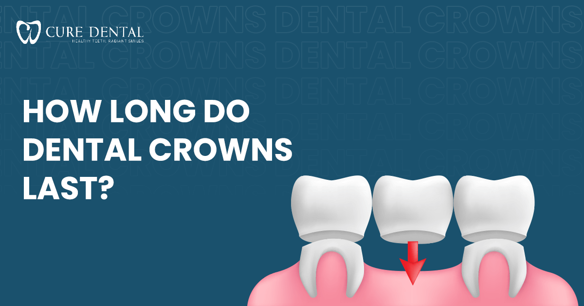 How Long Do Dental Crowns Last? | Cure Dental