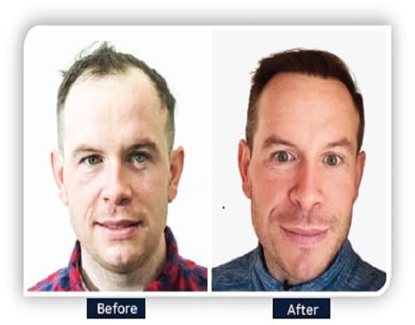 A Comprehensive Guide to Hair Restoration | by Ailesbury Hair Clinic | May, 2024 | Medium