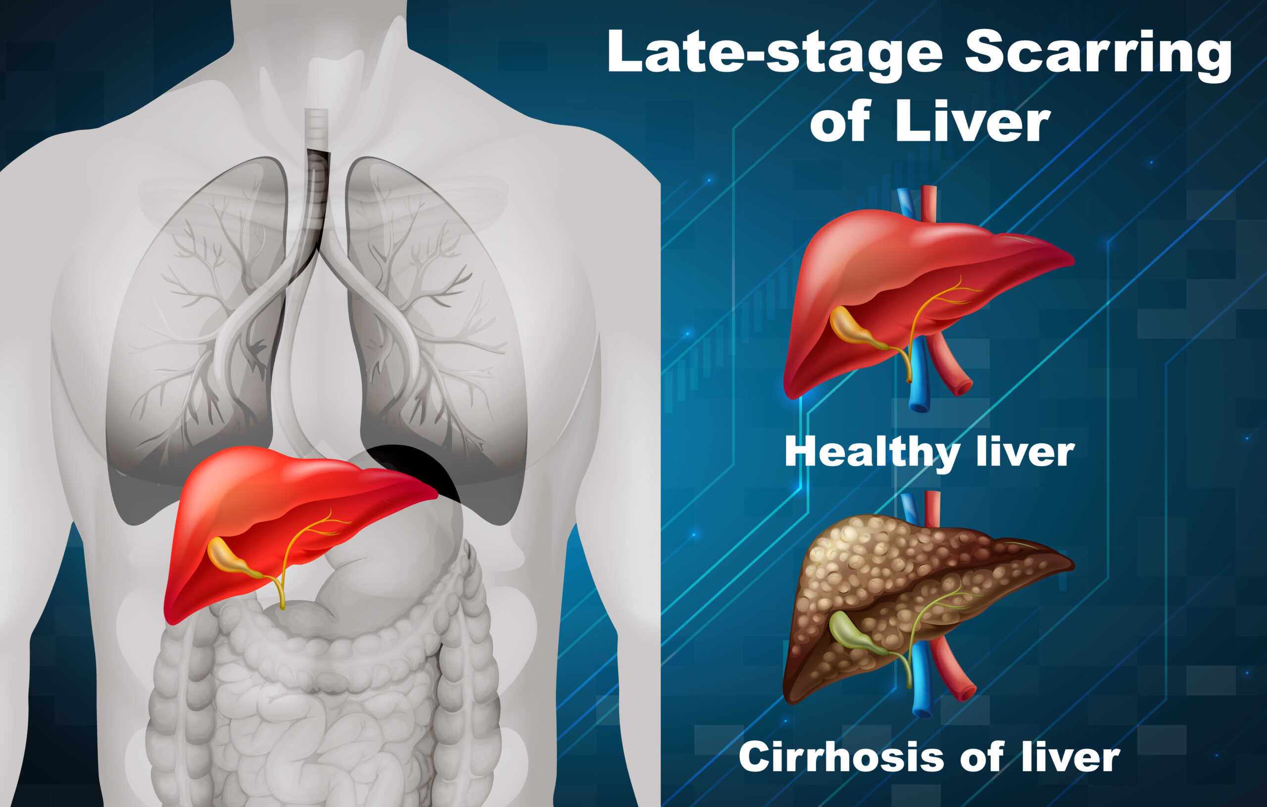 Liver Transplantation: All You Need To Know About This Vital Lifeline Procedure