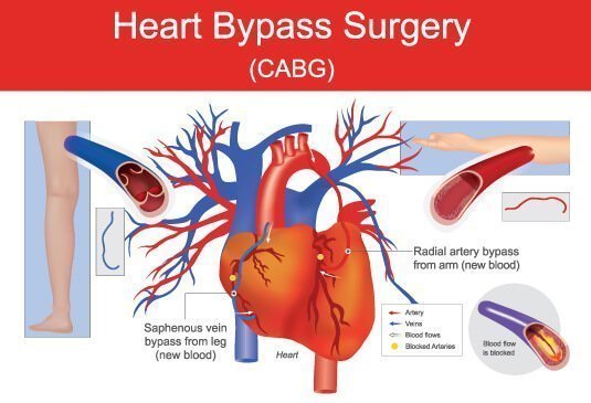 CABG Treatment in India | Heart Bypass Surgery Cost in India