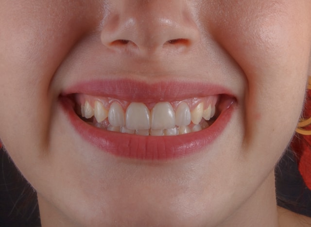 6 Dental procedures for a shining set of teeth