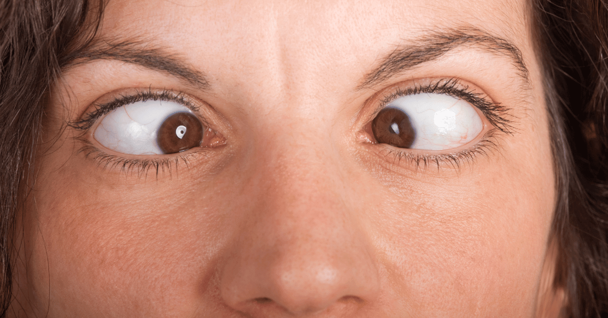 Squint Eye: Treatment Options and Risks for Adults