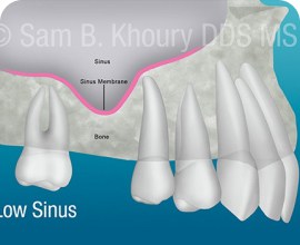 Kennett Dental Implants: Expert Care for Your Smile