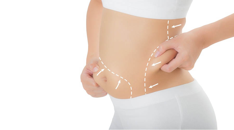 Understanding Liposuction: The Procedure and Its Purpose